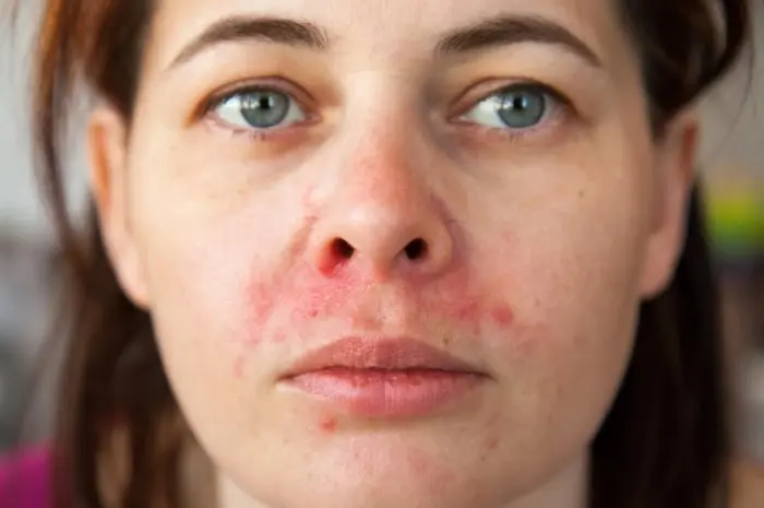 All You Need to Know About Perioral Dermatitis and Its Treatment