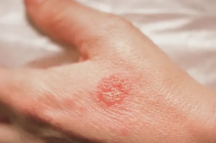 How to Get Rid of Nummular Eczema Naturally