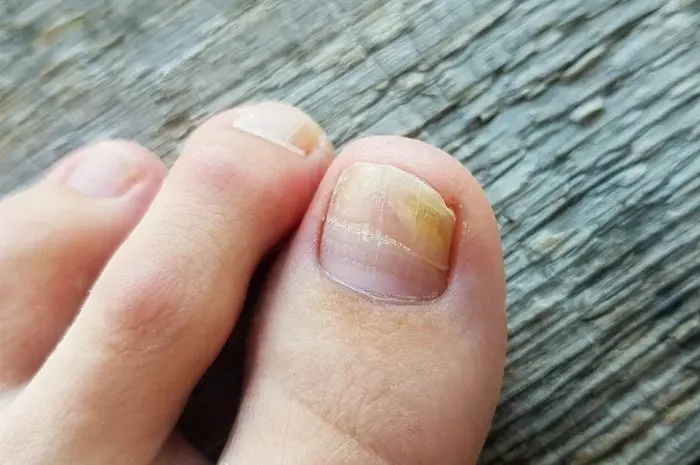 Nail Fungus Infection and Their Treatment