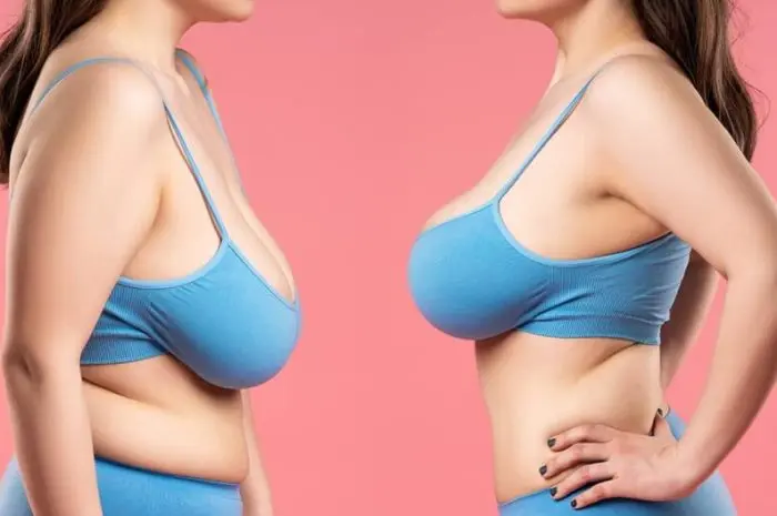 What to Expect from A Breast Lift Surgery?